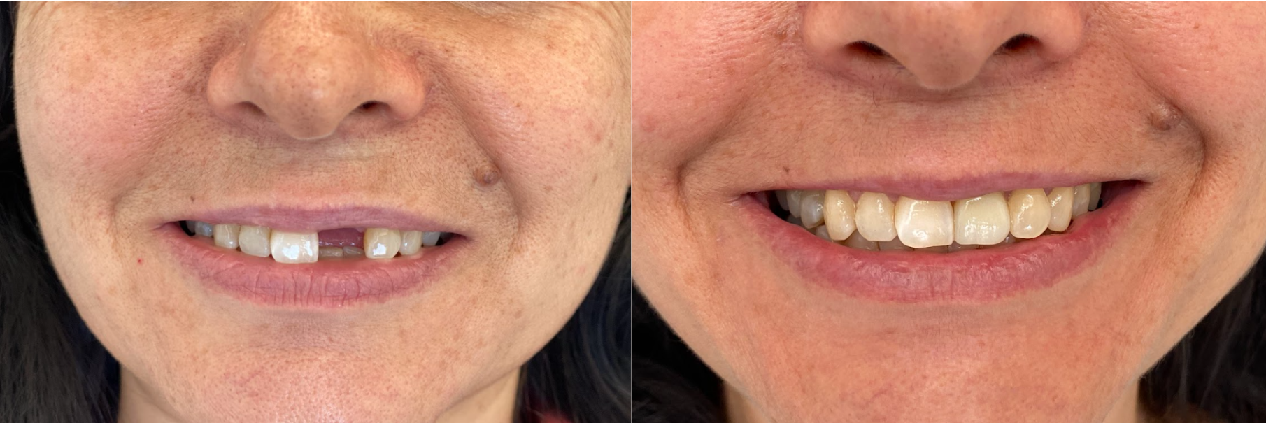 antes-depois2